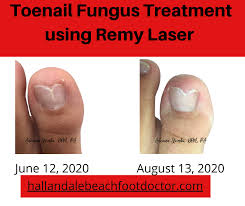 laser toenail fungus removal treatment