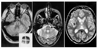 Putaminal Slit Brain Stories
