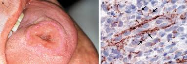 Image result for syphilis ulcer