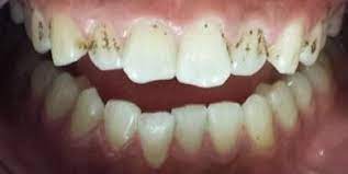 How Do You Get Rid Of Black Spots On Teeth Black Teeth Black Spot Teeth