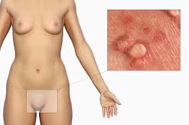 Bartholin's cysts manifest as firm, somewhat tender masses, and although they may occur at any age, they usually affect women in their reproductive years. From Varicose Veins To Cancer What Are Those Lumps Down There And When You Should See Your Gp