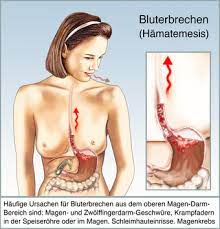 Bluterbrechen Hamatemesis Ursachen Behandlung Hilfe Medlexi De