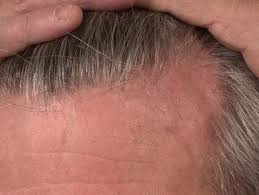 Home » medical » keratosis pilaris keratosis pilaris (kp) describes bumpy, dry skin caused by hair follicles becoming plugged by dry skin cells. Lassueur Graham Little Piccardi Syndrome