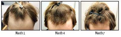 Finasteride won't reverse hair loss, but like minoxidil, it can slow receding hairlines in 60% to 80% of cases if taken faithfully, according to yates. Receding Hairline Prevent And Regrow A Receding Hairline