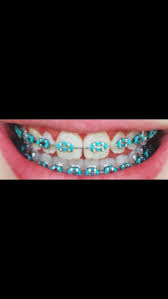 Teal Braces Front Teeth Changing Dental Braces Braces Teeth Colors Braces