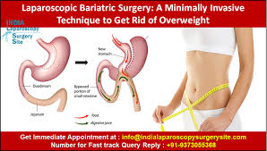 Laparoscopic Bariatric Surgery A Minimally Invasive Technique To Get Rid Of Overweight