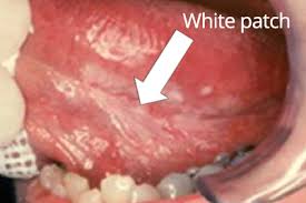 They perform functions like preventing the same ad from continuously reappearing. Mouth Cancer Atkinson Brignall Sevenoaks Kent