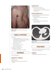 Image result for Pectus Excavatum