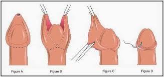 Anak anda dinasihatkan agar mengelakkan pergerakan cergas dalam jangkamasa 24 jam selepas berkhatan. Bebird Buta Kalau Anak Medical Mythbusters Malaysia ÙÙŠØ³Ø¨ÙˆÙƒ