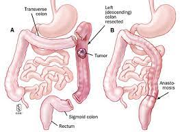 Eleven patients with benign postoperative colonic strictures were treated with balloon dilatation november, 1990, through november, 1995. ç›´è‚›å¤–ç§' Colorectal Resections ç™½è¢ææ‡¼ç—‡ ç—žå®¢é‚¦