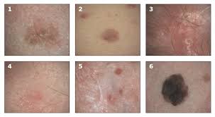 Of course, your specialist is the main person whose advice you should follow but it doesn't do anyone harm. Examples Of Melanoma And Non Melanoma Skin Cancer Taken In A Clinical Download Scientific Diagram