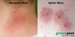 Image result for mosquito bite
