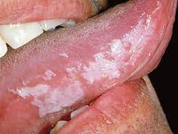 Some of the known causes being smoking, tobacco, alcohol, bacterial/fungal infection, uv radiation etc. What Is Leukoplakia Everything You Need To Know Cards Dental
