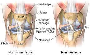 A locked knee due to meniscus tear can be terribly painful and difficult to deal with. Nyc Meniscus Tear Treatment Doctor Torn Meniscus Treatment