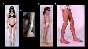 Image result for Lipodystrophy