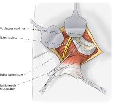 Products.bestreviews.com has been visited by 1m+ users in the past month Offene Refixation Bei Proximalen Hamstring Verletzungen Springerlink