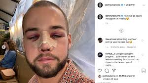 De onderste rij van zijn gebit met facings is namelijk donkerder dan de bovenste. Donny Roelvink Deelt Heftige Before En After Foto S Neuscorrectie Rtl Nieuws