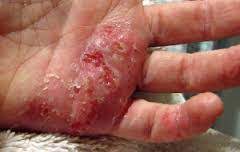 Disini anda juga bisa mendapatkan obat herbal yang terbukti ampuh mengatasi eksim. Obat Eksim Basah Di Apotik Kimia Farma De Nature Indonesia Herbal