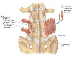 Back Pain New York Social Security Disability Lawyer