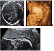 For example, ultrasound findings that may be suggestive of trisomy 13 may include holoprosencephaly, polydactyly, and growth retardation. Epos Trade