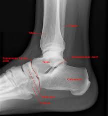 Image result for Ankle XRay