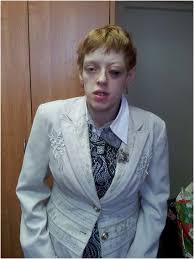 Image result for Homocystinuria