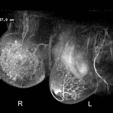 The scan helps to identify. Inflammatory Breast Cancer Eurorad