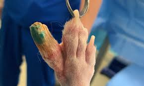 Image result for toe amputation