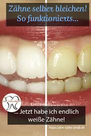 Das bleichen eines einzelnen zahns kostet 70 bis 150 euro. Pin Auf Zahngesundheit