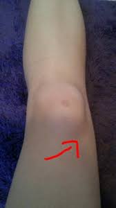 Woche mit schmerzen im oberschenkel, ganz oben an der innenseite. Knie Oberschenkel Schmerzen Gesundheit