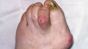 Image result for Hammer toe