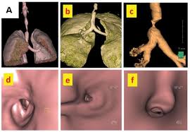 Image result for Virtual Endoscopy