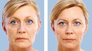 Case #79 this patient desired fuller lips and achieved this look using juvederm ultra plus. See What Juvederm Looks Like On You Juvederm Canada