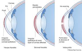 Many cases of hsv keratitis are due to an immune response. Eye Herpes Information Symptoms Treatment Options