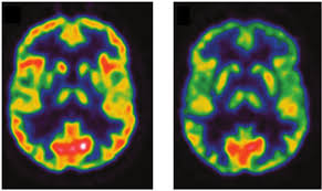 The positron emission tomography/computed tomography (pet/ct) scanner, in which pet and ct are combined. Brain 2 18f Fluoro 2 Deoxy D Glucose Positron Emission Tomography Download Scientific Diagram