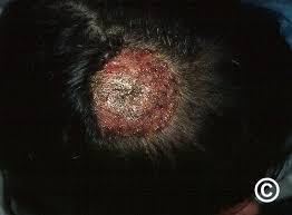 Image result for Tinea Capitis
