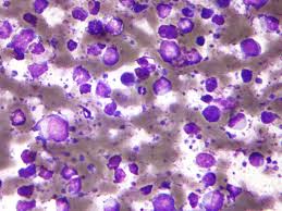 Image result for Lymphoma