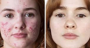 Maybe you would like to learn more about one of these? Como Eliminar Manchas Rojas De Acne Remedios Naturales Para El Acne Hemisferio Zero