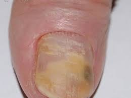 Maybe you would like to learn more about one of these? Causes Of A Loose Toenail Or Fingernail