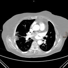 L'embolia polmonare è la terza più comune emergenza cardiovascolare dopo l'infarto miocardico acuto e l'ictus cerebrale e rappresenta la principale si parla di embolia polmonare (ep) quando un embolo ostruisce completamente o parzialmente uno o più rami dell'arteria polmonare (per le. Tromboembolia Polmonare