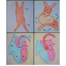 Pdf Truncus Arteriosus Communis Report Of Three Cases And Review Of Literature