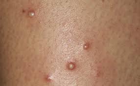 If you remove hair on your chest, you are likely to get those hair. Causes Cures For Itchy Vaginal Lumps Bumps And Sores Youmemindbody