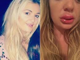 2 ﻿ immediately after getting lip injections, there is some degree of swelling, which is completely normal. Mum S Warning To Others After Lip Fillers Leave Her Infected And Swollen Nottinghamshire Live
