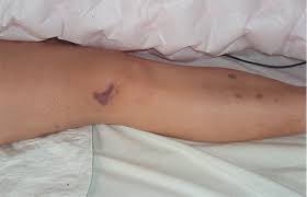 Very rarely, the virus can spread in transfused blood, a transplanted organ, or through the placenta to a fetus. Meningitis Amboss