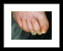 Image result for Onychogryphosis feet