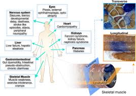 Image result for Myopathy