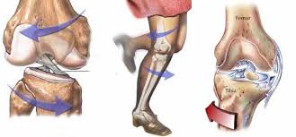 Kreuzbandriss Hufte Knie Orthozentrum Cham Zug Schweiz Orthopadische Chirurgie Dr Med Rolf F Oetiker