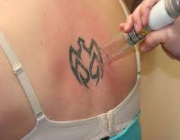 There are many different tattoo removal methods out there, but none compare to the tattoo vanish® method. Various Methods Of Removing Tattoos Tattoo Removal Dublin