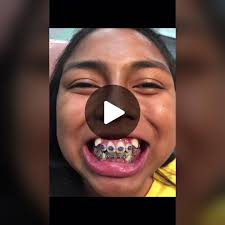 Corrección de Caninos Ectópicos en Ortodoncia