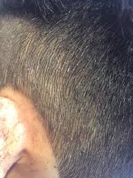 Beberapa faktor penyebab kulit kepala gatal. Kulit Kepala Gatal Frien Hair Studio Kb Padang Bank Facebook